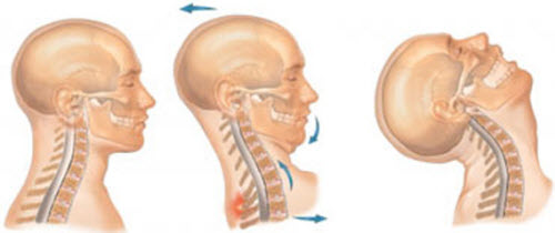 آسیب شلاقی گردن و کاربرد درمانی گردنبند طبی