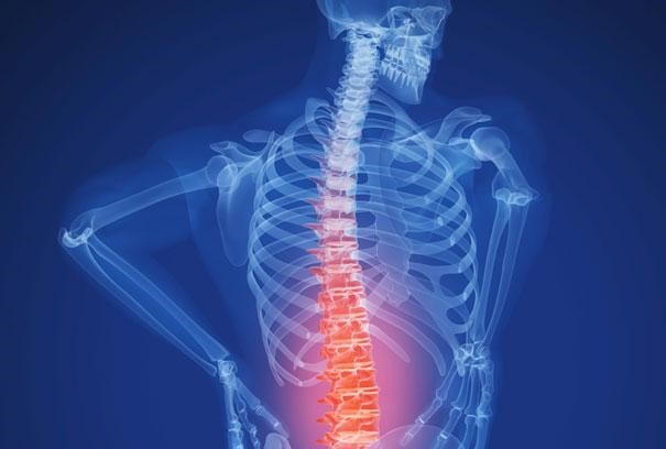 عوارض فیوژن ستون فقرات
