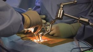 عمل جراحی بسته دیسک کمر یا عمل جراحی میکرودیسککتومی چیست؟