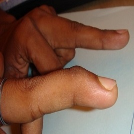 مالت فینگر(انگشت چکشی) و درمان سفتی،بی حرکتی،شکستگی و درد انگشتان